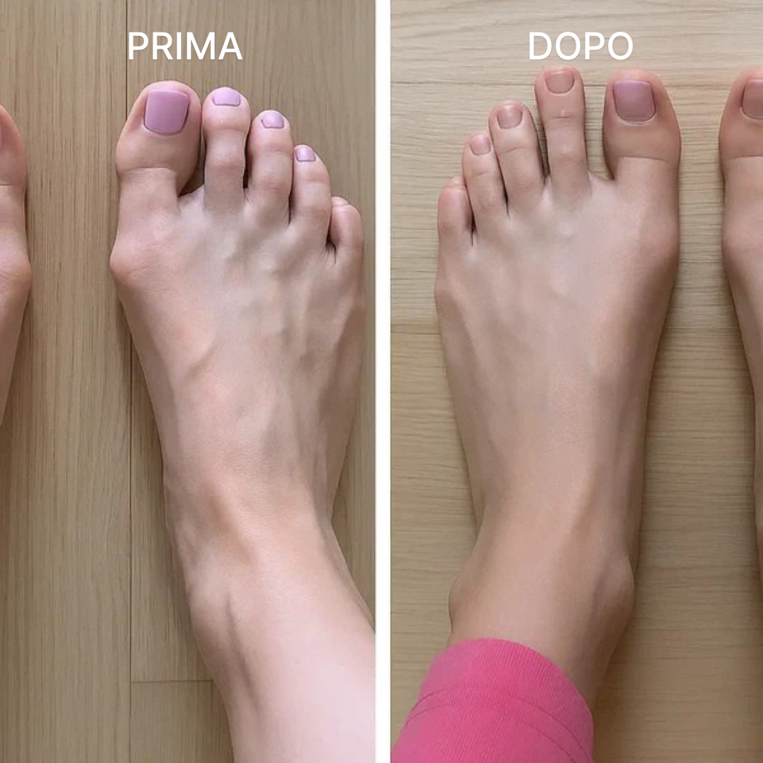 Valgux Tutore™ | Correttore dell’alluce valgo (Hallux Valgus)